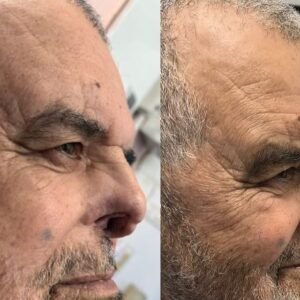 silicone-artificial-nose