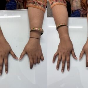 silicone-finger-prosthesis