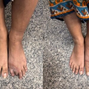 Silicone Toe Prosthesis