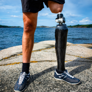 osseointegration-leg-prosthesis