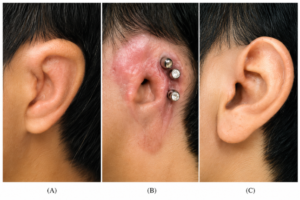 Osseointegration Ear Prosthesis