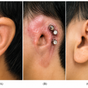 osseointegration-ear-prosthesis