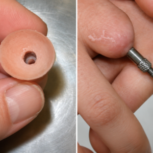 Osseointegration Finger Prosthesis