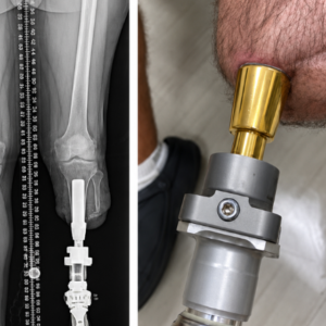 Osseointegration Leg Prosthesis