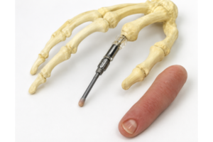 Osseointegration Finger Prosthesis