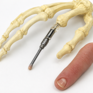 osseointegration-finger-prosthesis