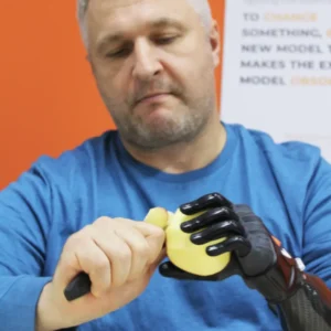 Prosthetic Hand Cost in India