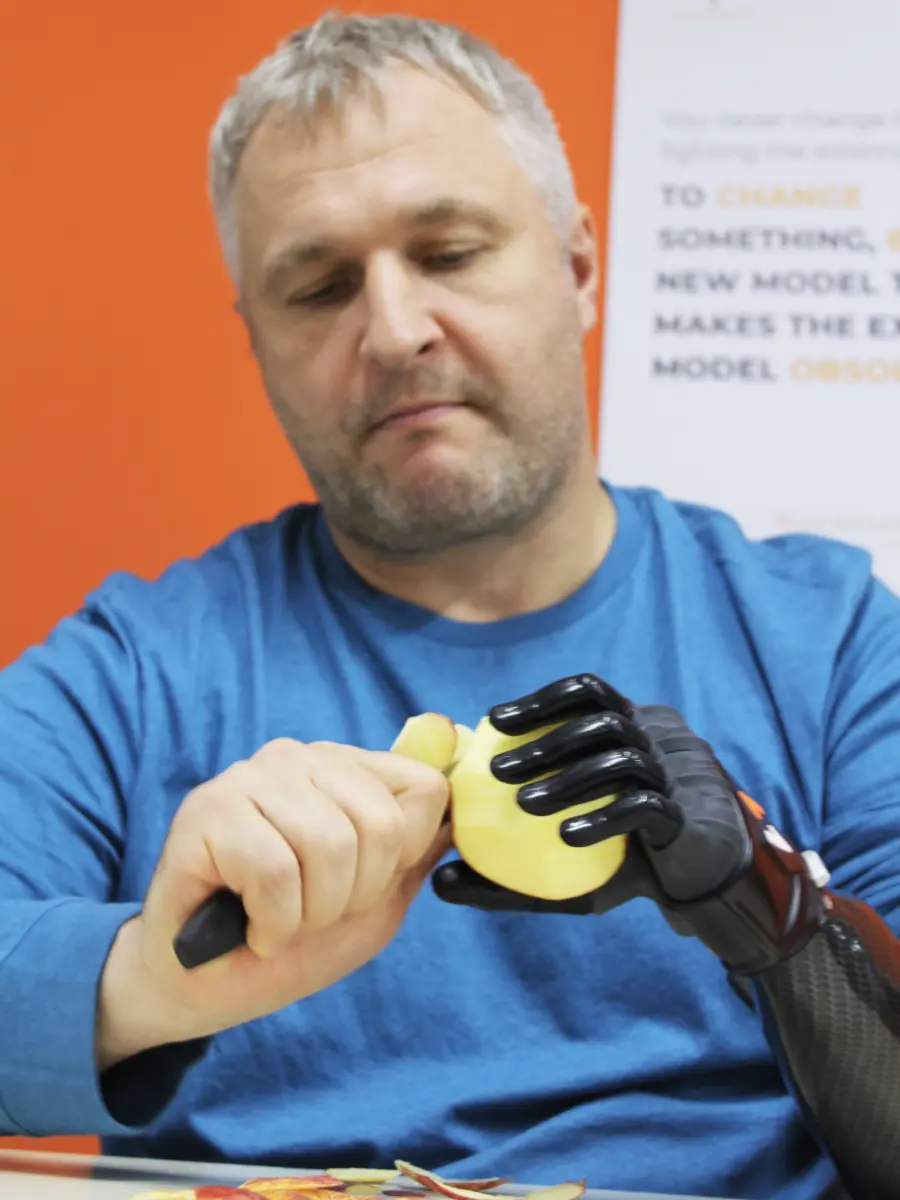 Prosthetic Hand Cost in India - Image 2