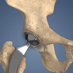 Prosthetic HIP Joint