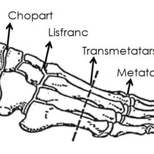 Partial Foot Silicone Prosthesis