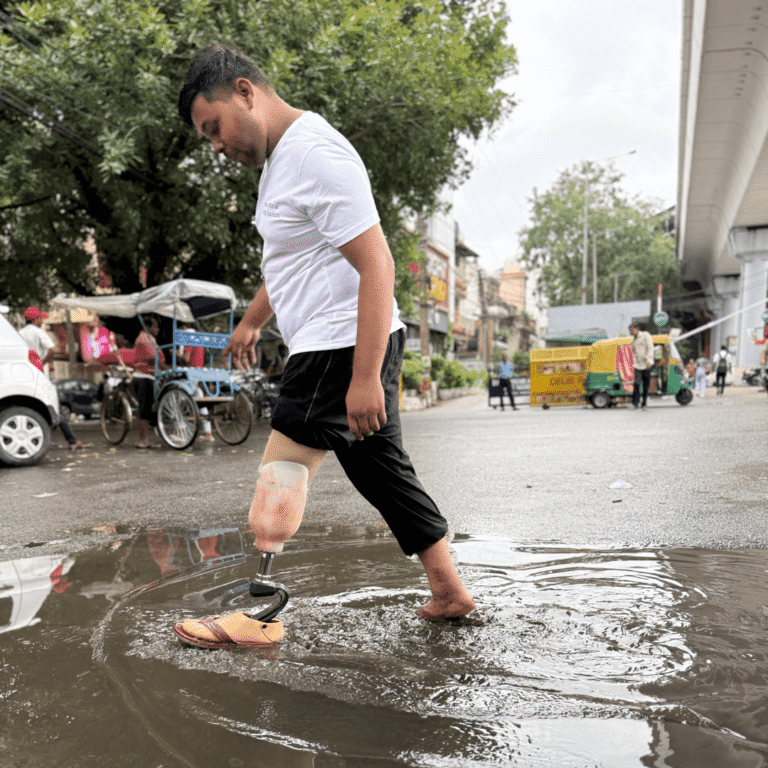 Read more about the article Monsoon & Prosthetic Legs: 7 Simple Tips to Stay Safe Dry & Confident This Rainy Season