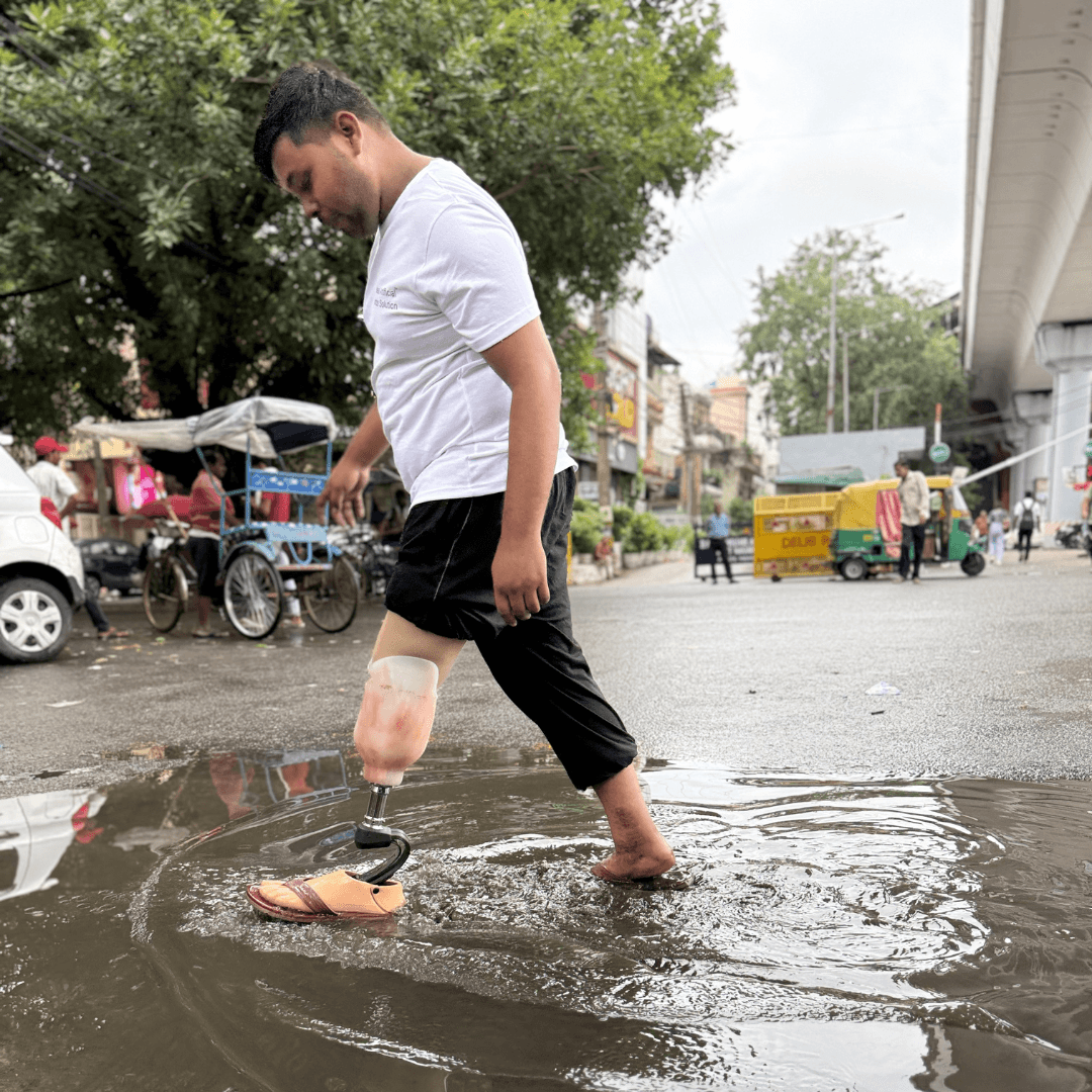 Read more about the article Monsoon & Prosthetic Legs: 7 Simple Tips to Stay Safe Dry & Confident This Rainy Season