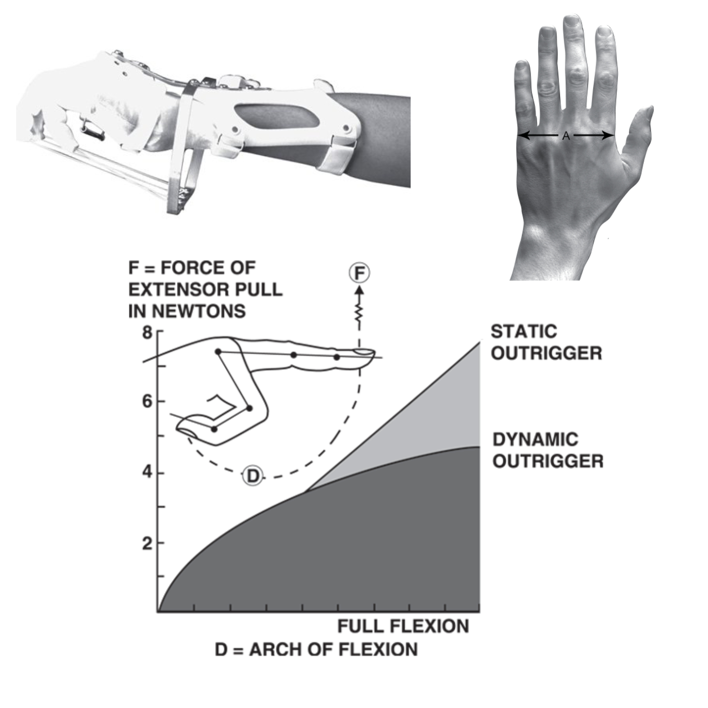 Dynamic Wrist Hand Orthosis With Finger Flexion